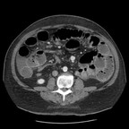 Volvulus du caecum avec signes de souffrances digestives TDM Abdomen Axial Temps veineux Volvulus du caecum avec signes de souffrances digestives TDM Abdomen Axial Temps veineux