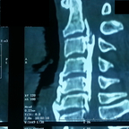 Maladie des japonais du rachis cervical TDM RACHIS CERVICAL Maladie des japonais du rachis cervical TDM RACHIS CERVICAL