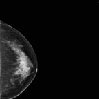 Tumeur bicentrique : carcinome canalaire infiltrant grade SBR II du QSI et carcinome canalaire in situ avec une composante infiltrante du QSE du sein gauche. LCC Tumeur bicentrique : carcinome canalaire infiltrant grade SBR II du QSI et carcinome canalaire in situ avec une composante infiltrante du QSE du sein gauche. LCC