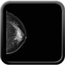 Tumeur bicentrique : carcinome canalaire infiltrant grade SBR II du QSI et carcinome canalaire in situ avec une composante infiltrante du QSE du sein gauche. LCC