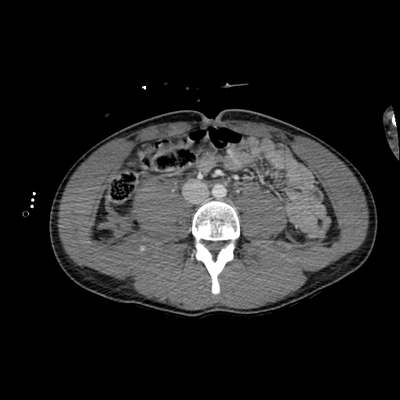 Cranioencephalic trauma, Facial fracture, Thoracic injuries, Pelvic fracture, Spleen and renal trauma Abdomen CT,  Portal venous phase, Axial plane
