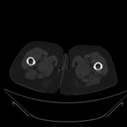 Migration de calcifications d'hydroxyapatite de l'insertion du grand glutéal TDM Axial fenetrage os Migration de calcifications d'hydroxyapatite de l'insertion du grand glutéal TDM Axial fenetrage os