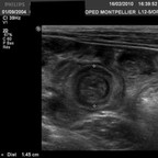 Invagination transitoire du grêle Echographie digestive Invagination transitoire du grêle Echographie digestive