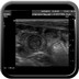 Invagination transitoire du grêle Echographie digestive