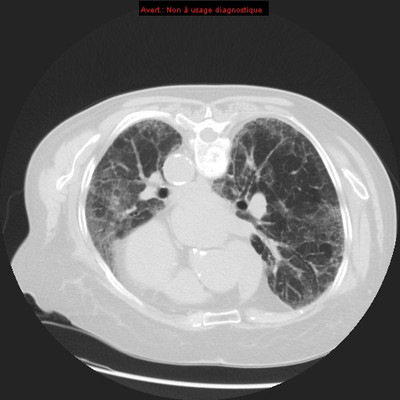 Pneumopathie interstitielle fibrosante à la cordarone Contrôle à 3 mois -  TDM Thorax Axial Procubitus
