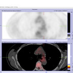Adénocarcinome bronchique métastatique TEP images clés et reconstructions Adénocarcinome bronchique métastatique TEP images clés et reconstructions
