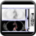 Adénocarcinome bronchique métastatique  TEP images clés et reconstructions