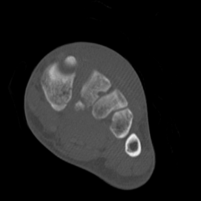 Traumatic diaphragmatic rupture, Thoracic and abdominal injuries, burst vertebral fracture, foot injuries Left foot, Coronal plane, Bone window