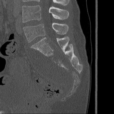 Tuberculose sacrée avec volumineux abcès Sacrum os sagittal