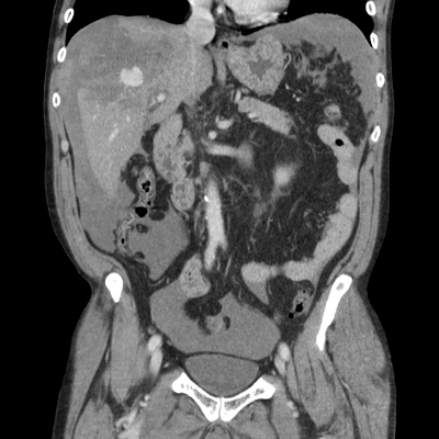 Hepatic fracture, Active hemorrhage Abdomen CT,  Portal venous phase, Coronal plane