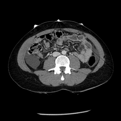 Abdominal vessels trauma, Intraperitoneal bladder rupture, Spleen infarction, Pelvic fracture Abdomen CT, Portal venous phase, Axial plane