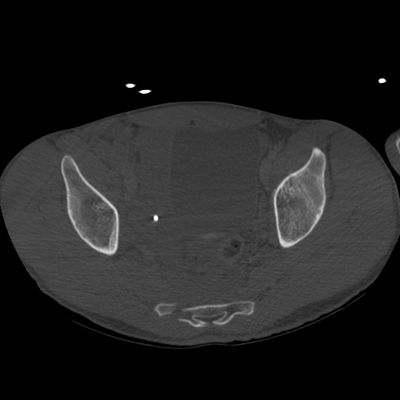 Thoracic Injuries, Subcapsular hemorrhage of liver, Pelvic injury Pelvis, Axial plane, Bone window