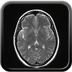 Orbitopathie basedowienne avec exophtalmie droite de grade I T2 TSE TRA