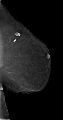 Récidive tardive de cancer du sein gauche LML Acquisition Tomo