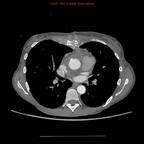 Ostéite sternale post-sternotomie TDM Thorax Axial Temps artériel Ostéite sternale post-sternotomie TDM Thorax Axial Temps artériel