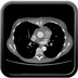 Ostéite sternale post-sternotomie  TDM Thorax Axial Temps artériel