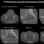 CT Pelvimetry ct-pelvimetry-normal-measurments-of-pelvis-obstetric CT Pelvimetry ct-pelvimetry-normal-measurments-of-pelvis-obstetric