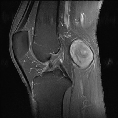 Anévrysme poplité thrombosé T1 FS Gadolinium Sagittal