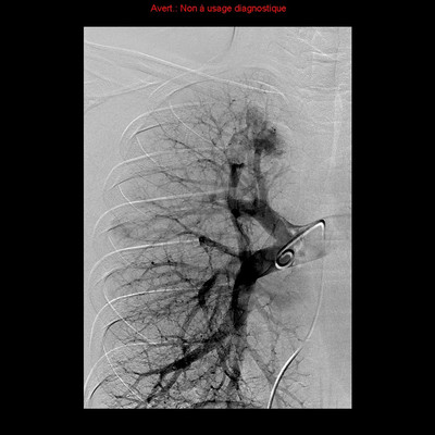 Hereditary hemorrhagic telangiectasia with lung arteriovenous malformation Right lung angiography