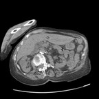 Angiocholite aigue lithiasique TDM Abdomen Pelvis Axial Sans injection Angiocholite aigue lithiasique TDM Abdomen Pelvis Axial Sans injection