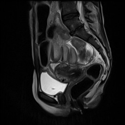 Rectal obstruction due to endometriosis Sagittal T2