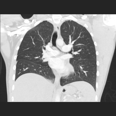 Pneumopathie infectieuse de la base droite Coronal Parenchyme