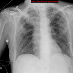 Aspergillome pulmonaire et pneumopathie infectieuse Radiographie Thorax Aspergillome pulmonaire et pneumopathie infectieuse Radiographie Thorax