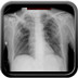 Aspergillome pulmonaire et pneumopathie infectieuse  Radiographie Thorax