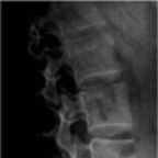 kyste anevrysmal de L5: évolution radiologique Image1 kyste anevrysmal de L5: évolution radiologique Image1