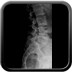 kyste anevrysmal de L5: évolution radiologique Image1