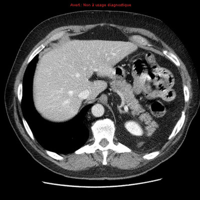 Tumeur maligne médiastinale antérieure (thymome B3) et myasthénie  TDM Thorax Abdomen controlle à 7 ans