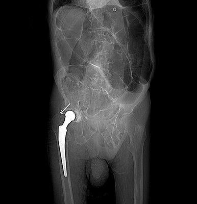 Volvulus du sigmoïde Face (scout)