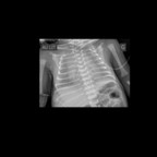 maladie des membranes hyalines Radiographie Thorax Face maladie des membranes hyalines Radiographie Thorax Face