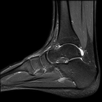 Séquelles post traumatiques du ligament collatéral latéral IRM DP fat sat