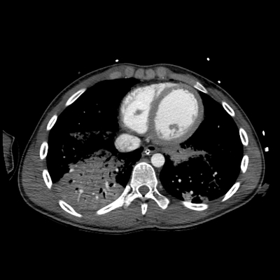 Cranioencephalic trauma, Facial fracture, Thoracic injuries, Pelvic fracture, Spleen and renal trauma Chest, Abdomen and Pelvis, Arterial phase, Axial plane