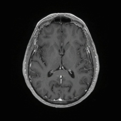 Schwannome cochléovestibulaire (neurinome de l'acoustique) T1 3D GADO AXIAL_MPR_Tra