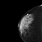 Carcinome canalaire in situ de grade intermédiaire RCC Carcinome canalaire in situ de grade intermédiaire RCC