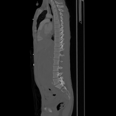 rupture de la veine rénale, hématome de la surrénale  TAP sagittal os