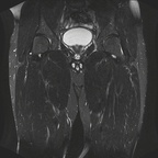 Enthésopathie long adducteur IRM Membre inférieur Coronal STIR Enthésopathie long adducteur IRM Membre inférieur Coronal STIR