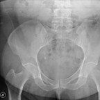 Fracture de contrainte de la tête fémorale chez une patiente ménopausée bassin de face Fracture de contrainte de la tête fémorale chez une patiente ménopausée bassin de face