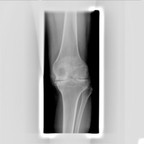 Arthropathie hémophyllique évoluée avec chondropathie grade IV tri compartimentale Radiographie Genou Face Arthropathie hémophyllique évoluée avec chondropathie grade IV tri compartimentale Radiographie Genou Face