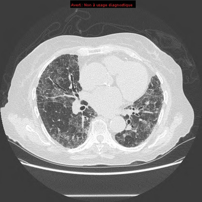 Pneumopathie interstitielle fibrosante à la cordarone  TDM Thorax Axial millimétrique