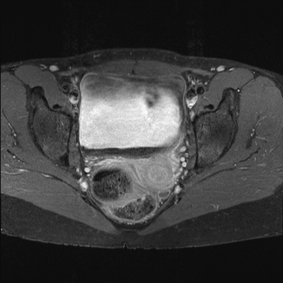 Volumineux fibrome sous-séreux pédiculé avec remaniements oedémateux Axial T1 Fat Sat Gado