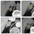 Adenoma of suprarenal gland adrenal-mass-adenoma-ct-algorythm Adenoma of suprarenal gland adrenal-mass-adenoma-ct-algorythm