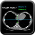 Pectus excavatum Haller-index-Pectus-excavatum