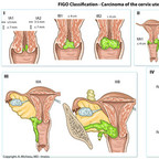 Carcinoma of the cervix uteri FIGO-Classification-Carcinoma-of-the-cervix-uteri Carcinoma of the cervix uteri FIGO-Classification-Carcinoma-of-the-cervix-uteri
