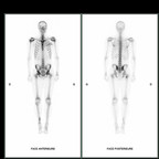 Dysplasies fibreuses de decouverte fortuite. Méd. nuc. Dysplasies fibreuses de decouverte fortuite. Méd. nuc.