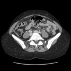 Abcès tubo ovarien bilatéral et pelvi péritonite TDM Abdomen Axial Temps veineux Abcès tubo ovarien bilatéral et pelvi péritonite TDM Abdomen Axial Temps veineux