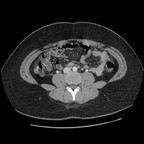 Pyosalpinx droit et gauche avec pelvi péritonite et abcès au niveau du cul de sac de Douglas. TDM Abdomen Axial Temps veineux Pyosalpinx droit et gauche avec pelvi péritonite et abcès au niveau du cul de sac de Douglas. TDM Abdomen Axial Temps veineux