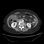 Cholecystite lithiasique gangreneuse TDM Abdomen Pelvis Axial veineux Cholecystite lithiasique gangreneuse TDM Abdomen Pelvis Axial veineux